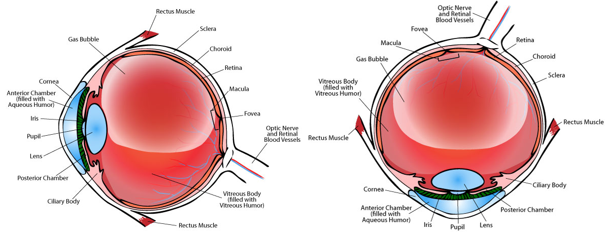 bubble in eye after retina surgery